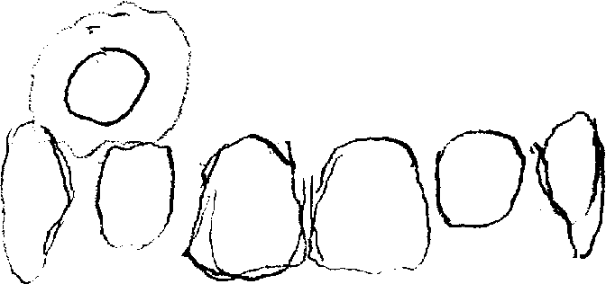 示意图：贴片位于牙齿上方的位置